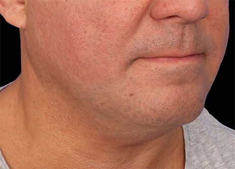 Emface_PIC_Ba-115-card-male-after-submentum_ENUS100_1706022455_original