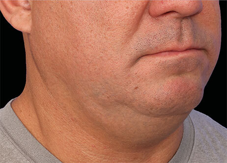 Emface_PIC_Ba-115-card-male-before-submentum_ENAU100_1711633326_original