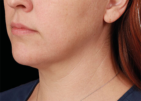 Emface_PIC_Ba-117-card-female-after-submentum_ENUS100_1706022457_original