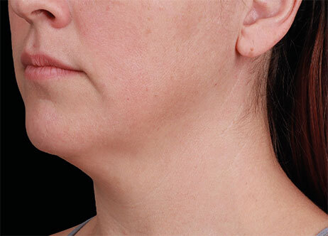 Emface_PIC_Ba-117-card-female-before-submentum_ENUS100_1706022458_original