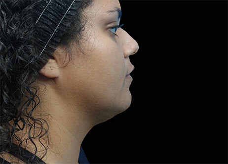 Emface_PIC_Ba-118-card-female-after-submentum_ENAU100_1711633327_original