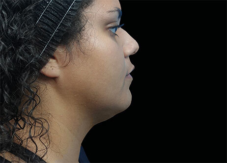 Emface_PIC_Ba-118-card-female-after-submentum_ENUS100_1706022459_original