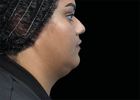 Emface_PIC_Ba-118-card-female-before-submentum_ENAU100_1711633327_original