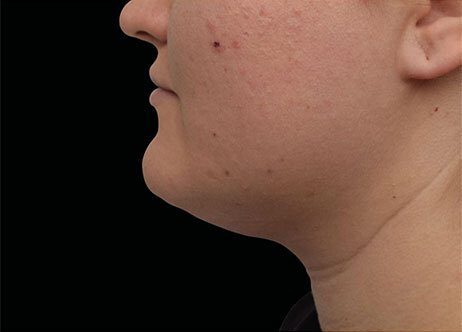 Emface_PIC_Ba-121-card-female-after-submentum_ENUS100_1706022460_original