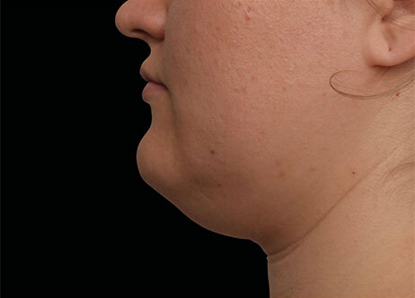 Emface_PIC_Ba-121-card-female-before-submentum_ENUS100_1706022461_original