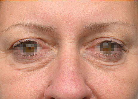 Emface_PIC_Ba-card-160-female-eyes-before_EN100_1737622780_original