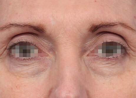 Emface_PIC_Ba-card-164-female-eyes-after_EN100_1737622781_original