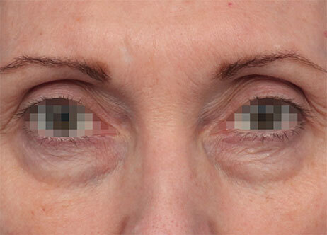Emface_PIC_Ba-card-164-female-eyes-before_EN100_1737622781_original