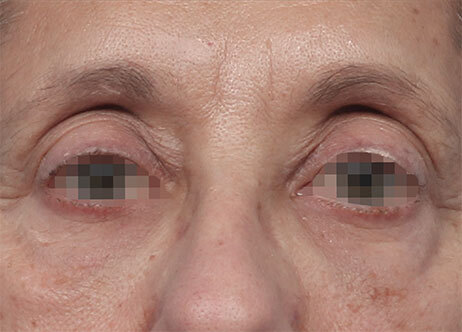 Emface_PIC_Ba-card-171-female-eyes-after_EN100_1737622778_original