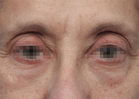 Emface_PIC_Ba-card-171-female-eyes-before_EN100_1737622779_original