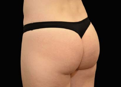 Emsculpt_Neo_PIC_045-after-last-tx-buttock-female-Klaus-Hoffman-MD_412x296px_1616750975_original_1713442057_original