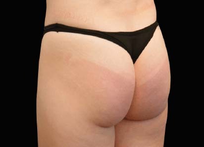 Emsculpt_Neo_PIC_045-before-buttock-female-Klaus-Hoffman-MD_412x296px_1616750977_original_1713442057_original