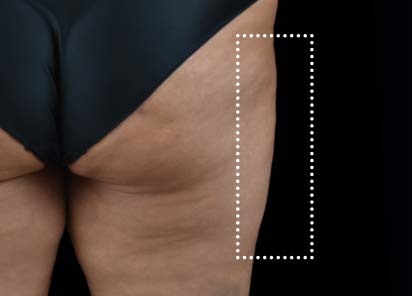 Emsculpt_Neo_PIC_060-after-outer_thighs-female-BTL-Aesthetics-1M-412x296px_1621339704_original_New_1713447535_original