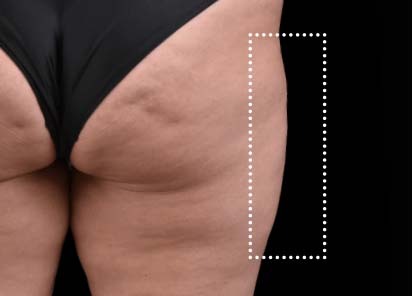 Emsculpt_Neo_PIC_060-before-outer_thighs-female-BTL-Aesthetics-412x296px_1621339709_original_New_1713447535_original