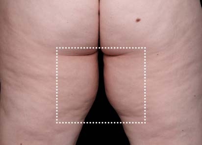 Emsculpt_Neo_PIC_062-after-inner_thighs-female-Diane-Duncan-MD-1M_412x296px_1621339714_original_New_1713447536_original