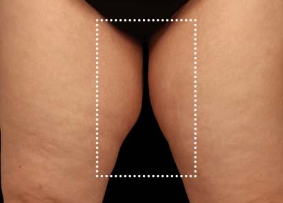 Emsculpt_Neo_PIC_063-after-inner_thighs-female-Diane-Duncan-MD_412x296px_1621339723_original_New_1713447537_original