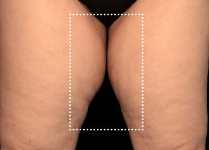 Emsculpt_Neo_PIC_063-before-inner_thighs-female-Diane-Duncan-MD_412x296px_1621339728_original_New_1713447537_original