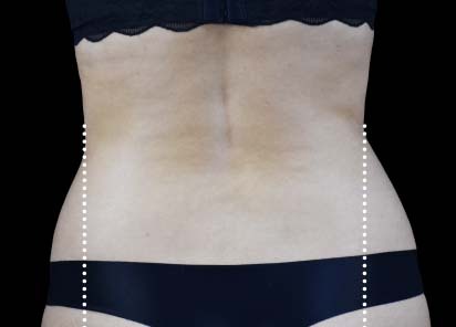 Emsculpt_Neo_PIC_101-after-lateral-abdomen-female-BTL-Aesthetics__412x296px_1663051284_original_New_1713447830_original