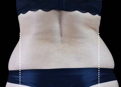 Emsculpt_Neo_PIC_101-before-lateral-abdomen-female-BTL-Aesthetics__412x296px_1663051287_original_New_1713447830_original