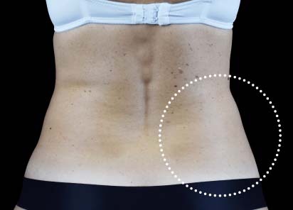 Emsculpt_Neo_PIC_103-after-lateral-abdomen-female-BTL-Aesthetics__412x296px_1663051289_original_New_1713447831_original
