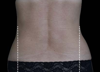 Emsculpt_Neo_PIC_117-after-lateral-abdomen-female-BTL-Aesthetics__412x296px_1663051295_original_New_1713447832_original