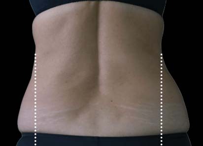 Emsculpt_Neo_PIC_117-before-lateral-abdomen-female-BTL-Aesthetics__412x296px_1663051297_original_New_1713447832_original