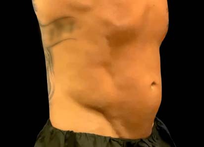 Emsculpt_Neo_PIC_123-before-lateral-abdomen-male-JD-McCoy-NMD__412x296px_1663051303_original_New_1713447833_original