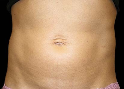 Emsculpt_PIC_008-After-abdomen-female-Katerina-Fajkosova-MD-4TX__412x296px_1589358973_original_1713448170_original