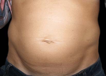 Emsculpt_PIC_008-Before-abdomen-female-Katerina-Fajkosova-MD__412x296px_1589358975_original_1713448170_original