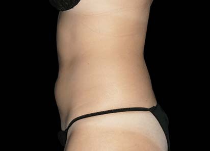 Emsculpt_PIC_010-After-female-Robert-Weiss-MD-6TX__412x296px_1589358977_original_1713448171_original