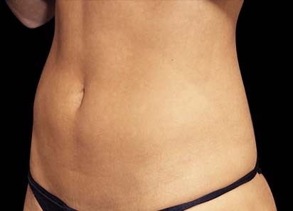 Emsculpt_PIC_011-After-abdomen-female-Suneel-Chilukuri-MD-4TX__412x296px_1589358980_original_1713448172_original