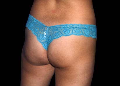 Emsculpt_PIC_012-Before-female-Mariano-Busso-MD__412x296px_1589359161_original_New_1713510489_original