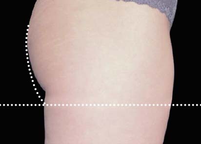 Emsculpt_PIC_015-After-female-Radina-Denkova-MD-4TX4W__412x296px_1589434573_original_New_1713510491_original