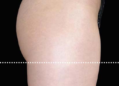 Emsculpt_PIC_015-Before-female-Radina-Denkova-MD__412x296px_1589434576_original_New_1713510491_original