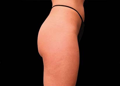 Emsculpt_PIC_016-Before-buttock-female-Brian-Kinney-MD__412x296px_1589434579_original_New_1713510492_original