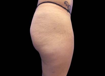 Emsculpt_PIC_017-After-buttock-female-Carolyn-Jacob-MD-4TX_412x296px_1602658241_original_1713442023_original