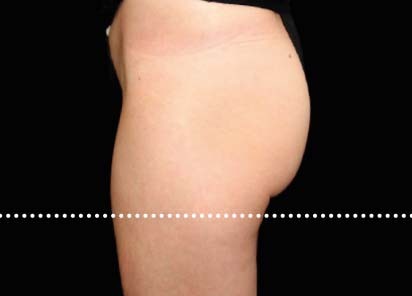 Emsculpt_PIC_020-After-buttock-female-Suneel-Chilukuri-MD-4TX__412x296px_1589434582_original_New_1713510493_original