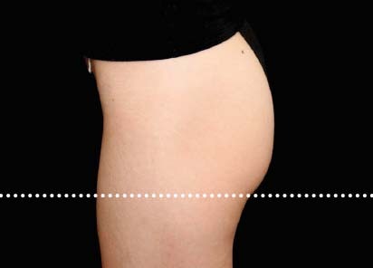 Emsculpt_PIC_020-Before-buttock-female-Suneel-Chilukuri-MD__412x296px_1589434584_original_New_1713510493_original