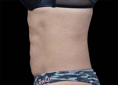 Emsculpt_PIC_022-After-abdomen-female-Paula-Lozanova-MD-4TX__412x296px_1589358992_original_1713448252_original