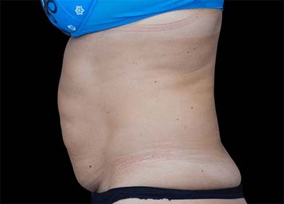 Emsculpt_PIC_022-Before-abdomen-female-Paula-Lozanova-MD_412x296px_1589359508_original_1713448252_original