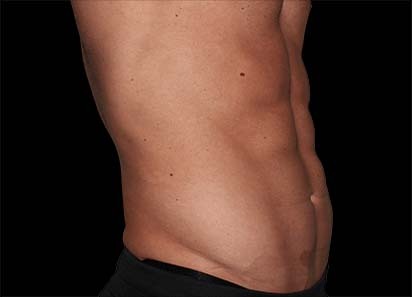 Emsculpt_PIC_036-After-abdomen-male-Edward-M-Zimmerman-MD-4TX_412x296px_1589358998_original_1713448254_original