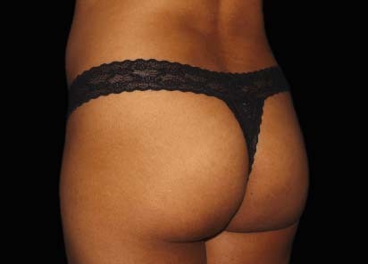 Emsculpt_PIC_036-After-buttock-female-Chris-Bailey-Ovation-Med-Spa-4TX__412x296px_1602658245_original_1713442024_original