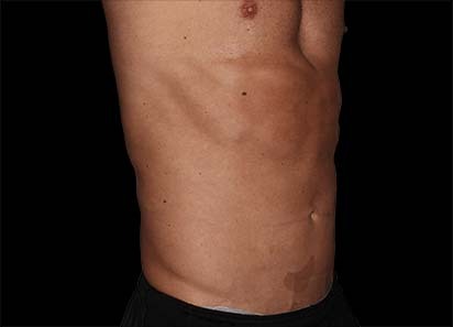 Emsculpt_PIC_036-Before-abdomen-male-Edward-M-Zimmerman-MD_412x296px_1589359001_original_1713448253_original