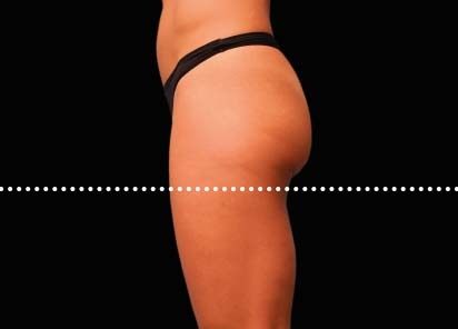 Emsculpt_PIC_042-After-buttock-female-Brian-Kinney-MD-4TX__412x296px_1589434589_original_New_1713510495_original