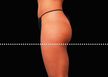 Emsculpt_PIC_042-Before-buttock-female-Brian-Kinney-MD__412x296px_1589434590_original_New_1713510494_original