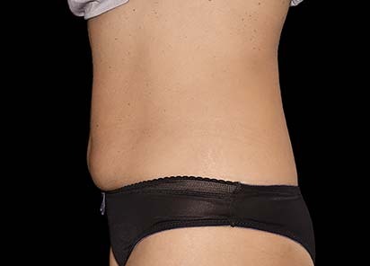 Emsculpt_PIC_045-after-female-Katia-Paskova-MD-4TX4W_412x296px_1589359003_original_1713448255_original