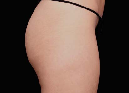 Emsculpt_PIC_049-After-buttock-female-Lasky-Aesthetics-4TX__412x296px_1602658249_original_1713442025_original