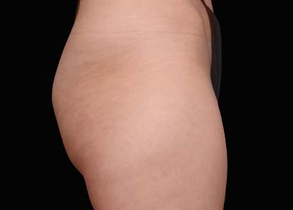 Emsculpt_PIC_049-Before-buttock-female-Lasky-Aesthetics__412x296px_1602658252_original_1713442024_original