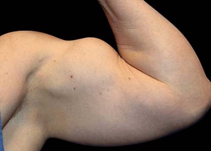 Emsculpt_PIC_074-after-arms-male-Reminder-Saluja-3W-4TX_412x296_1589434132_original_New_1713509153_original