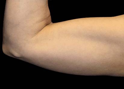 Emsculpt_PIC_075-After-arms-female-Reminder-Saluja-MD-3W-4TX_412x296_1589359091_original_New_1713509152_original